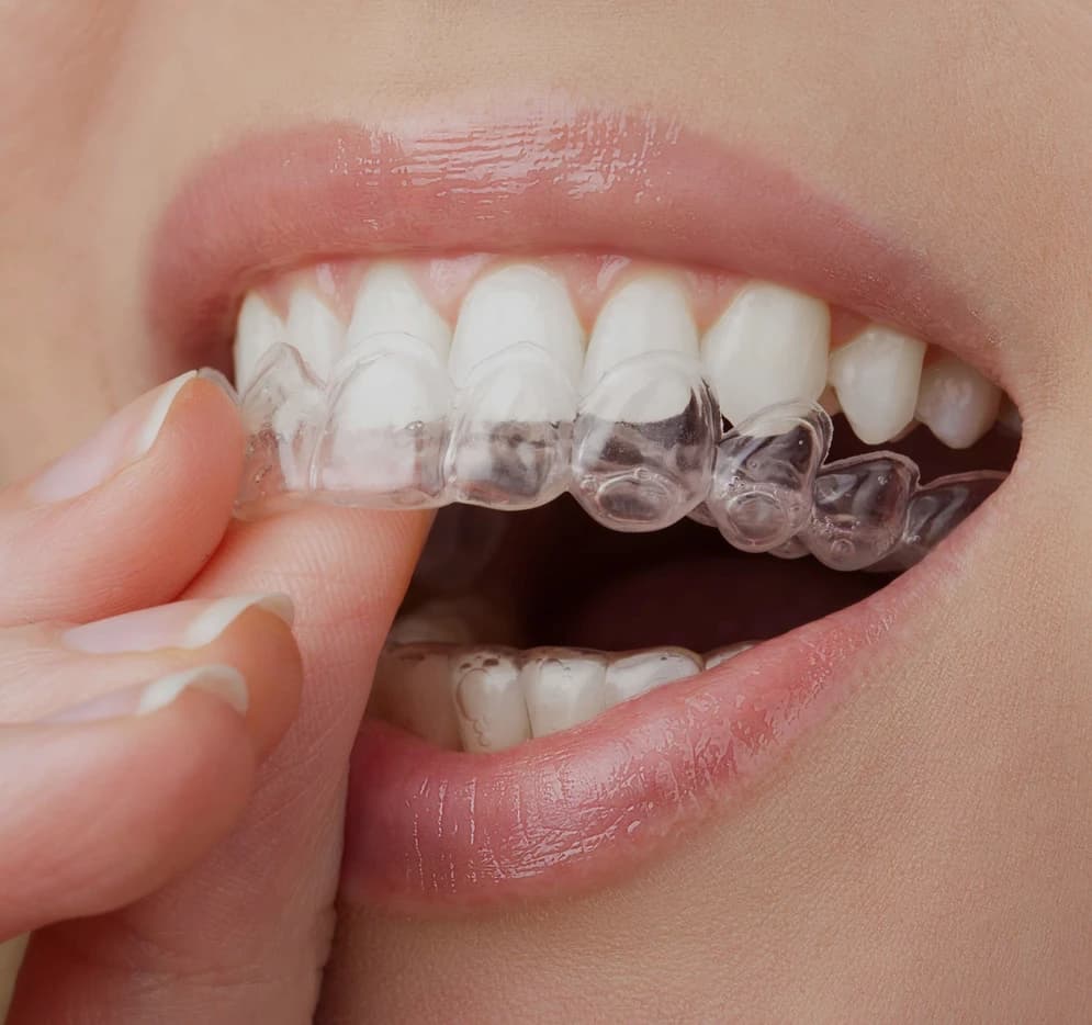 Invisalign clear aligner treatment preview